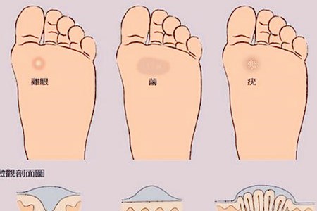 鸡眼怎么去除最好方法(涛哥教处理鸡眼的方法).jpg